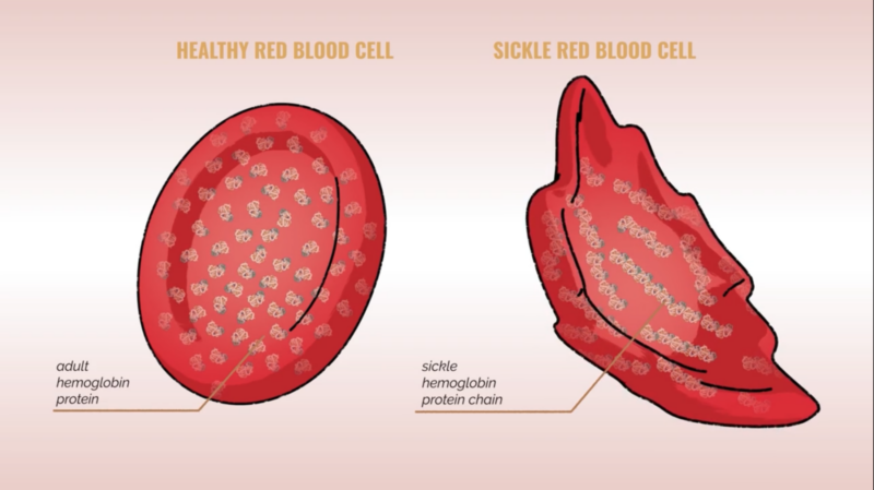 normalna hemoglobina u dorosłych vs hemoglobina sierpowata