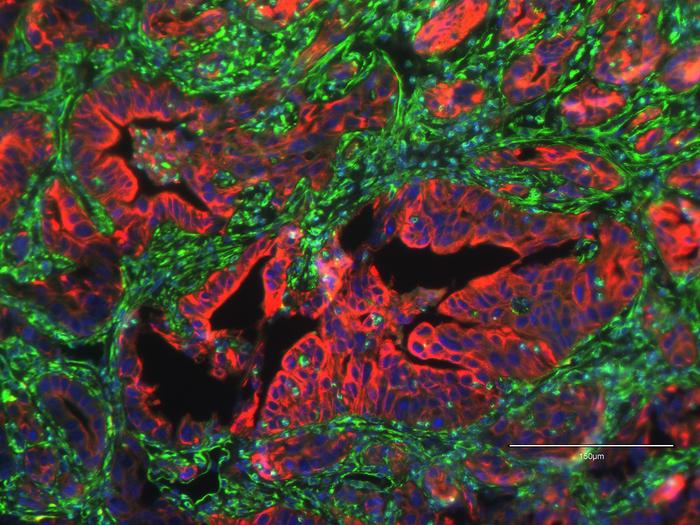 Naukowcy identyfikują białko powiązane z przerzutami w raku trzustki