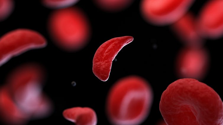 Komórki sierpowate mają inny kształt niż zdrowe okrągłe krwinki czerwone