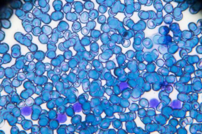 Ostra białaczka limfoblastyczna Rozmaz krwi ALL-L2 pod mikroskopem świetlnym