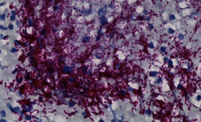 Bakterie związane z chorobami dziąseł powiązane z rakiem jelita grubego