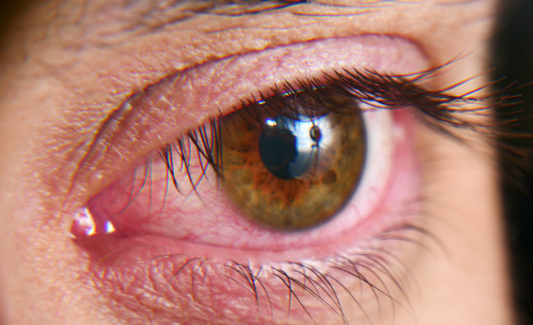 Naukowcy odkrywają mikrobiologiczne sekrety suchego oka