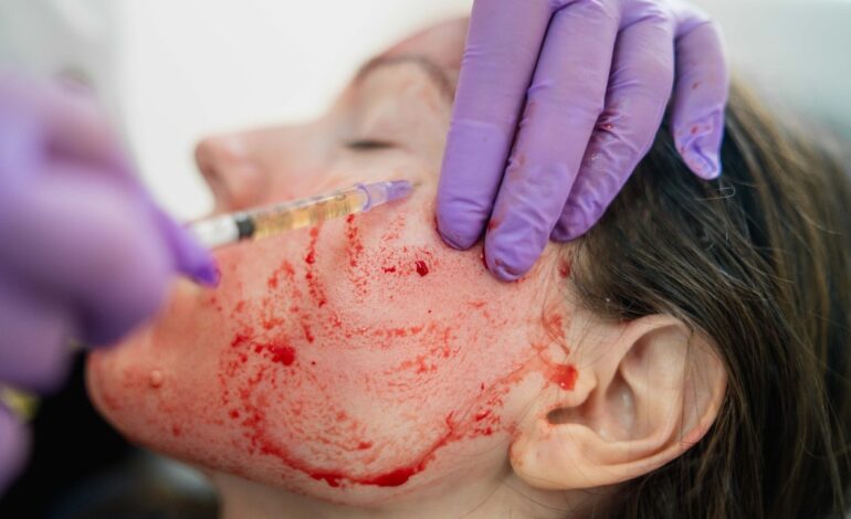 Kobiety zarażają się wirusem HIV po skorzystaniu z „wampirycznego zabiegu na twarz” w salonie