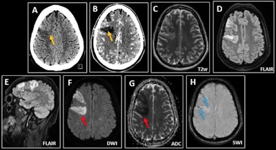 Zator septyczny u 40-letniego mężczyzny z bólem głowy i ostrym stanem splątania w kontekście bakteryjnego zapalenia wsierdzia.  (AB) CT wykazuje ogniskowy obszar obrzęku kory czołowej prawej strony, bardziej widoczny w fazie po podaniu kontrastu (żółte strzałki), zgodny z podostrym zawałem lub nowotworem o niskim stopniu złośliwości.  (CG) MRI wykazuje liczne rozproszone ogniska o zwiększonej intensywności na T2/FLAIR, z ograniczoną dyfuzją w obu półkulach mózgu, co sugeruje zawały zatorowe (czerwone strzałki).  (H) Dominujące zmiany w prawym płacie czołowym wiążą się z mikrokrwotokiem w obrazach ważonych wrażliwością (niebieskie strzałki).
