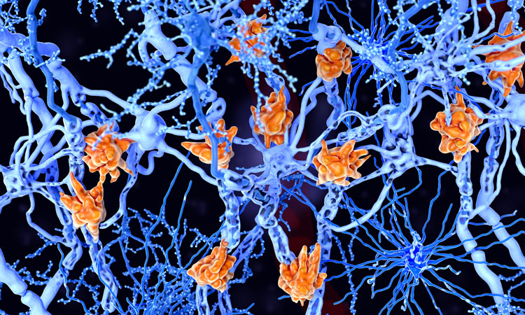Nowy biomarker bezobjawowych stadiów choroby Alzheimera