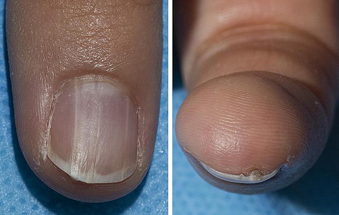 Łagodny stan paznokci powiązany z rzadkim zespołem, który znacznie zwiększa ryzyko raka