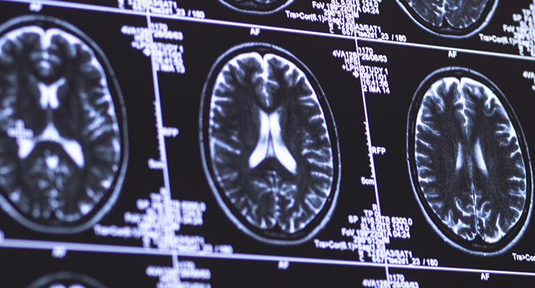 Skany mózgu pozwalają przewidzieć chorobę nawet do 9 lat wcześniej: ScienceAlert