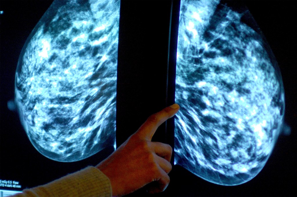 Osoba bada prześwietlenie w celu wykrycia raka w tkance piersi.