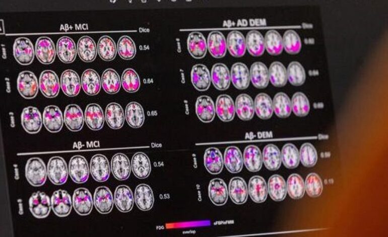 Czy chorobę Alzheimera naprawdę można odwrócić, jak twierdzi nowy dokument?