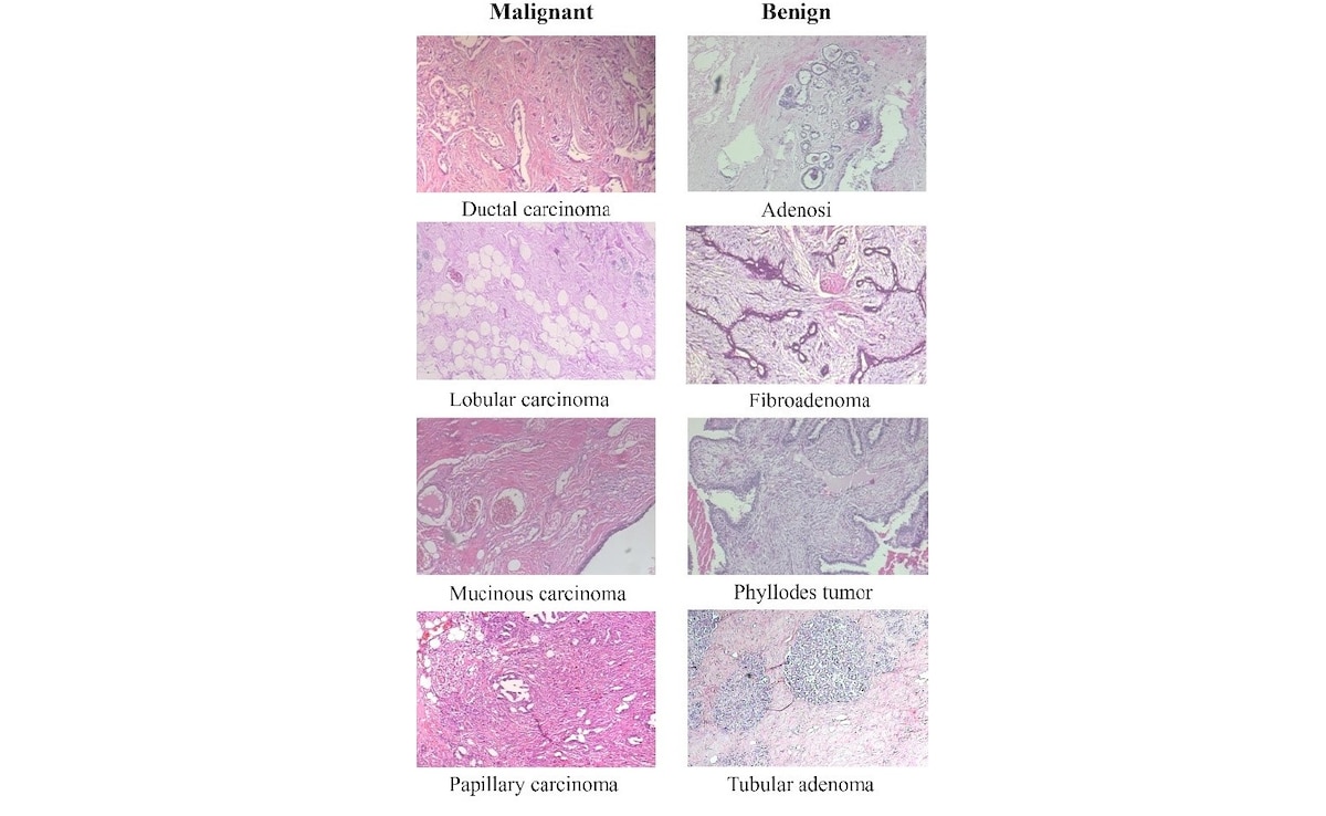 Reprezentatywne obrazy mikroskopowe złośliwych i łagodnych tkanek piersi z zestawu danych BreakHis (Źródło obrazu: Cancers 2024, 16(12), 2222)