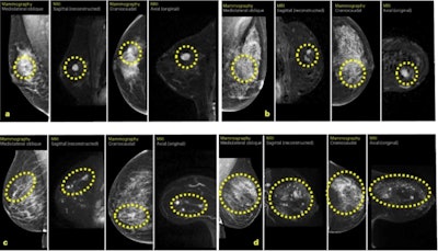 (A) Przypadek A to 13-mm duży wynik BI-RADS 4 w MRI, który odpowiadał 13-mm dużemu inwazyjnemu rakowi zdiagnozowanemu w próbce chirurgicznej. (B) Przypadek B to 9-mm duży wynik BI-RADS 4 w MRI, który odpowiadał 8-mm inwazyjnemu rakowi i 14-mm rakowi przewodowemu in situ. (C) Przypadek C to trzy podejrzane zmiany o łącznej powierzchni 60 mm, wynik BI-RADS 5 w MRI, który odpowiadał 50-mm wieloogniskowemu inwazyjnemu rakowi zrazikowemu. (D) Przypadek D to dwie podejrzane zmiany, największa 13 mm, BI-RADS 3 w MRI, która odpowiadała 10-mm inwazyjnemu rakowi zrazikowemu o zasięgu 85 mm, w tym rakowi przewodowemu in situ. Zdjęcia dzięki uprzejmości Nature Medicine. Na licencji CC BY 4.0.