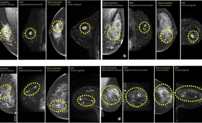 Sztuczna inteligencja zwiększa wykrywalność raka piersi metodą MRI czterokrotnie