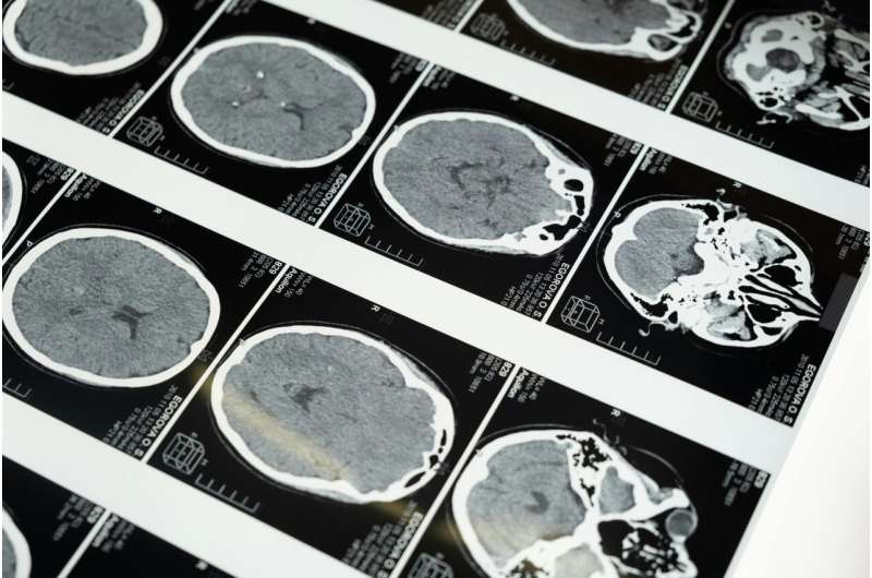 tomografia komputerowa mózgu