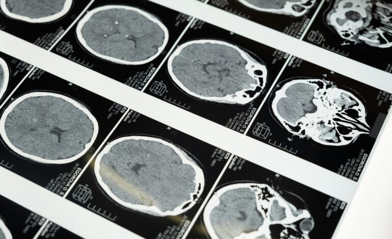 Jak sztuczna inteligencja może pomóc w diagnozowaniu łagodnych wstrząsów mózgu