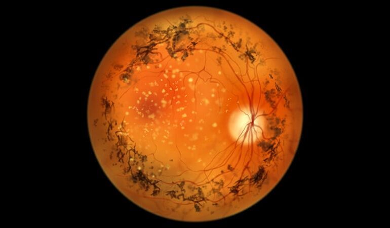 Nowa terapia genowa bezpieczna dla retinitis pigmentosa