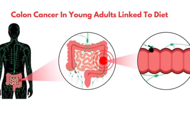 Nowe badanie ujawnia, że ​​dieta jest kluczowym czynnikiem ryzyka raka jelita grubego u młodych dorosłych | Wiadomości zdrowotne