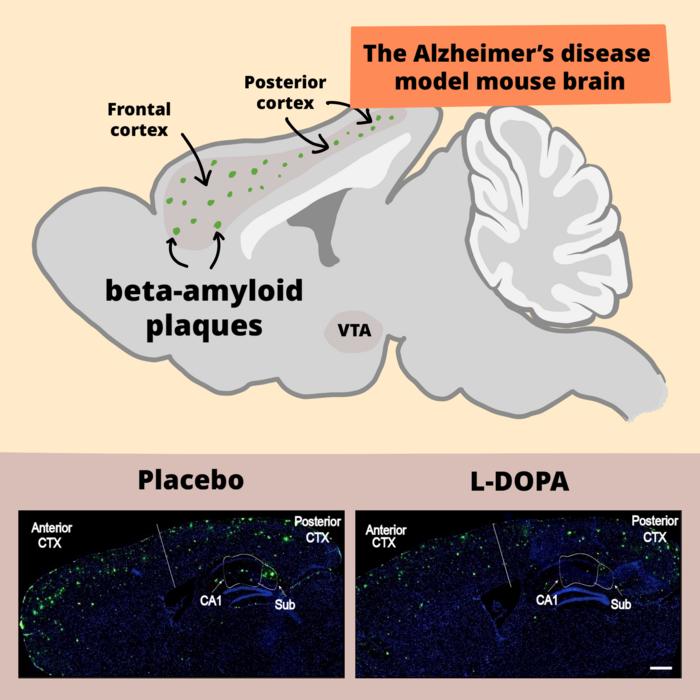 L-DOPA redukuje szkodliwe blaszki beta-amyloidu u myszy z modelem choroby Alzheimera 